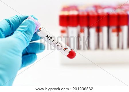 Blood sample with AFP (Alfa-fetoprotein, tumor marker for liver) positive