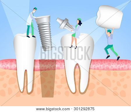 Dentists Install A Dental Implant. Dentistry. Implantation And Treatment Of Human Teeth. Vector Illu