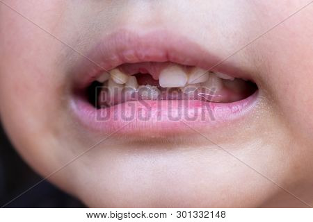 Little Child And Broken Teeth, Healthcare Concepy