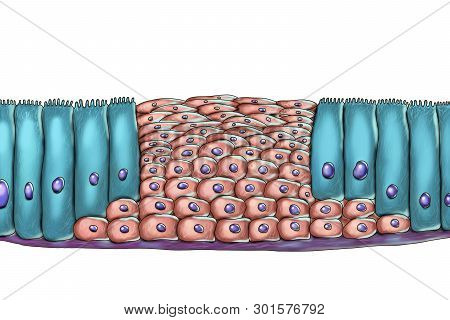 Squamous Metaplasia Or Respiratory Epithelium, A Consequence Of Cigarette Smoking , Illustration