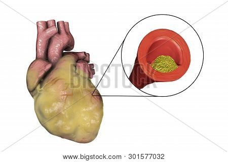 Atherosclerotic Plaque In Coronary Blood Vessel Of Obese Heart, 3d Illustration