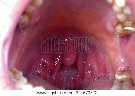 Tonsils Deformed, Tonsillitis, Neglected Poor Human Mouth Interior,