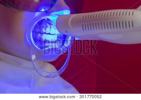 Teeth Whitening Procedure Ultraviolet Lamp Whiten Teeth Girl Mouth Extender