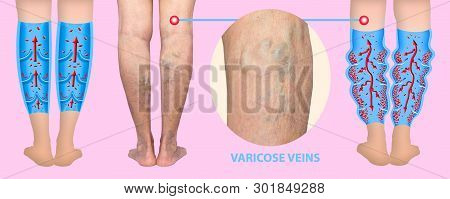 Varicose Veins On A Female Senior Legs. The Structure Of Normal And Varicose Veins. Concept Of Dry S