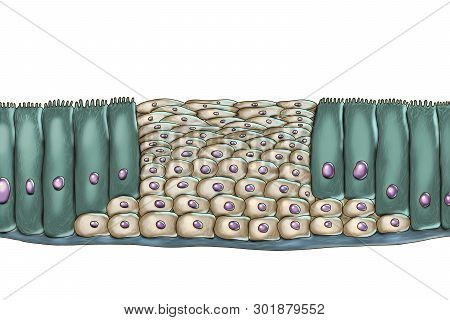 Squamous Metaplasia Or Respiratory Epithelium, A Consequence Of Cigarette Smoking , Illustration