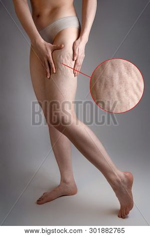A Woman Shows Her Hands Cellulite On Your Leg. The Concept Of Aesthetic Medicine And Skin Imperfecti