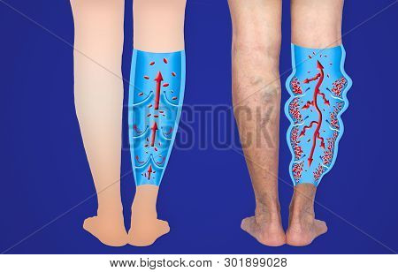 Varicose Veins On A Female Senior Legs. The Structure Of Normal And Varicose Veins. Concept Of Dry S