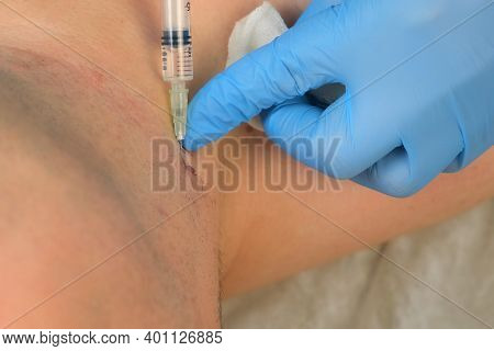 Surgeon In Gloves Gives Injection Of Local Anesthesia To Patient Before Laser Removing Mole, Closeup