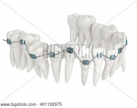 3D Render Of Teeth Alignment By Orthodontic Braces