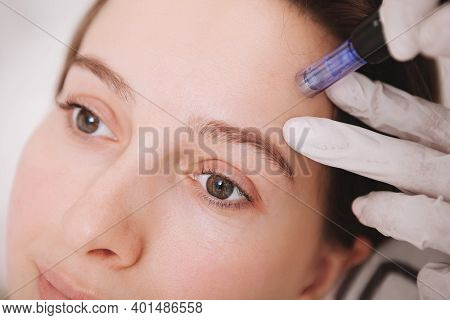 Close Up Of A Young Woman Receiving Microinjections In Her Forehead, Getting Mesotherapy Treatment B