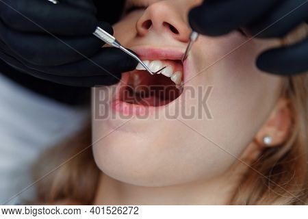Dentist Checks The Condition Of The Patients Gingivas With A Dental Probe. Diseases Of The Oral Cavi