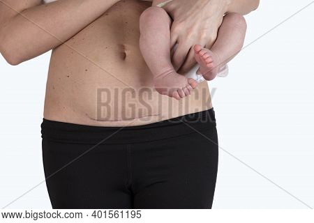 Closeup Of Woman Belly With A Scar From A Cesarean Section. Woman With Baby On Her Hand