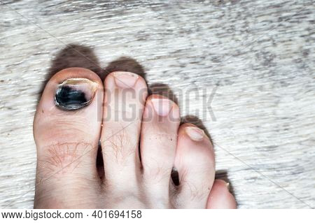 Blackened Nail On A Man's Big Toe. Nail Injury