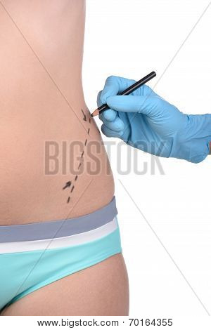 Anaplasty