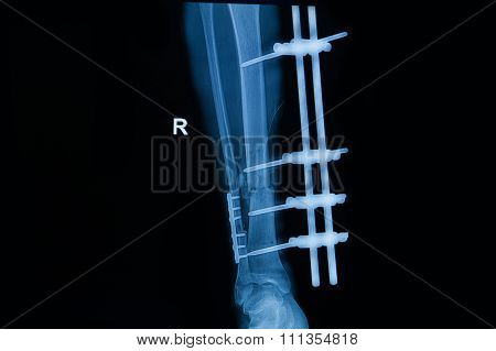 Collection Of Human X-rays  Showing Fracture Of Right Leg ,  Post  Operated With External Fixed