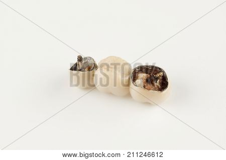 damaged cermet prosthesis with broken parts of teeth