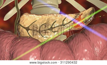 Pancreatic Cancer, Malignant Tumor Of Pancreas, 3d Illustration