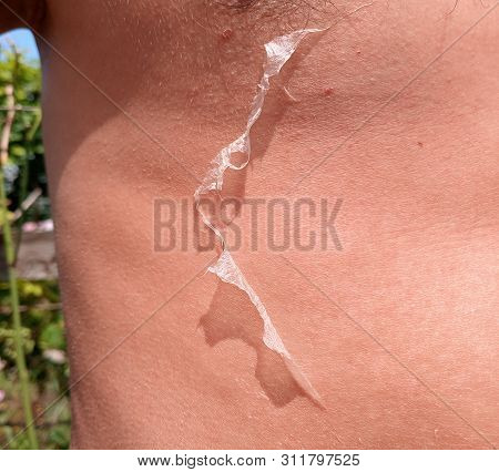 Exfoliation Of The Skin After Sunburn. Excessive Tan. The Effects Of Sunburn On The Skin. Climb Skin