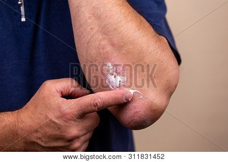 Concept Photo Of Treatment Of Skin Diseases Using Ointments As Dosage Form Of Drug. Patient Causes M