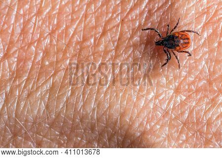 A Predatory Parasitic Tick On A Human Skin. Selective Focus.