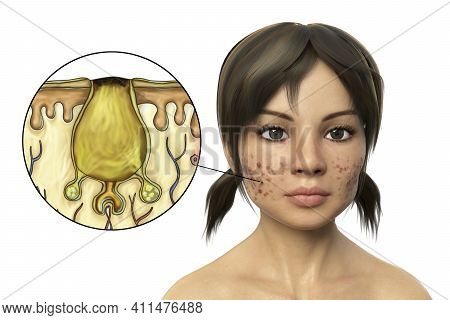 Acne Vulgaris, A Skin Condition Occuring When Dead Skin Cells And Oil From The Skin Clog Hair Follic