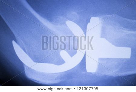 Knee Joint Orthopedic Replacement Implant