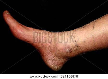 Leg. Varicose Veins. Phlebeurysm. Thrombophlebitis. Leg In Veins.