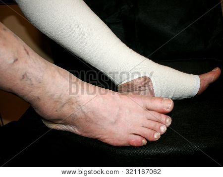 Leg. Varicose, Veins. Phlebeurysm. Thrombophlebitis. Elastic Bandage.