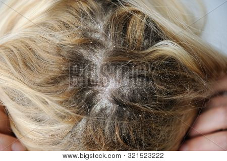 Dandruff Seborrhea Problem Of Scalp And Hair Treatment Of Peeling From Allergies Or Lichen