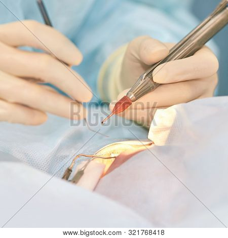 Ophthalmology Laser Microscope Operation. Doctor In Clinic. Patient Eye Treatment. Myopia And Catara