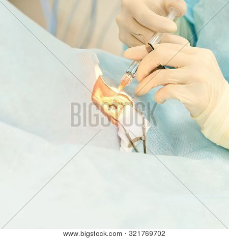 Ophthalmology Laser Microscope Operation. Doctor In Clinic. Patient Eye Treatment. Myopia And Catara