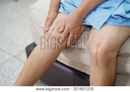 Asian Senior Or Elderly Old Lady Woman Patient Show Her Scars Surgical Total Knee Joint Replacement 