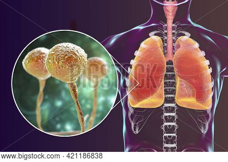 Lung Mucormycosis, A Lung Disease Caused By Fungi Mucor, Also Known As Black Fungus, With Close-up V