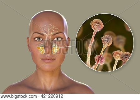 Aspergillus Fungi As A Cause Of Sinusitis. 3d Illustration Showing Inflammation Of Maxillary Sinuses