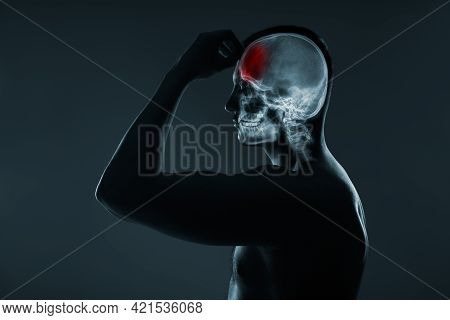 X-ray Of A Man's Head. Medical Examination Of Head Injuries. Cerebral Stroke. Frontal Part Of The Br