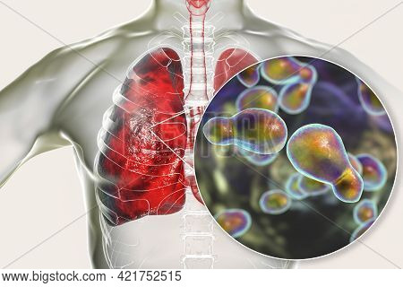 Pulmonary Cryptococcosis, Invasion Of A Lung Tissue By Yeast Fungi Cryptococcus Neoformans With Clos
