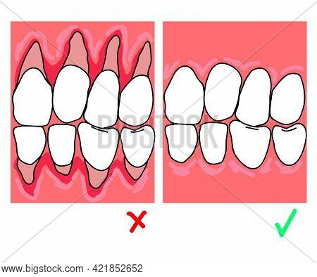 Exposure Of The Neck Of The Tooth. Cartoon. Vector Illustration.