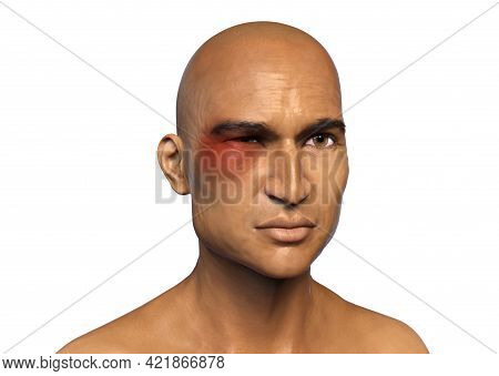 Periorbital Cutaneous Mucormycosis, A Disease Caused By Mucor Fungi