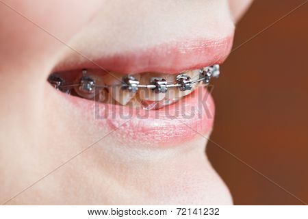Dental Braces On Teeth Of Upper Jaw Close Up