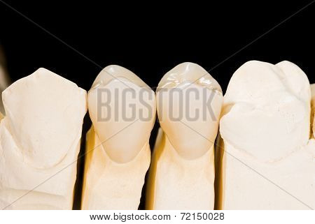 Ceramic Crowns