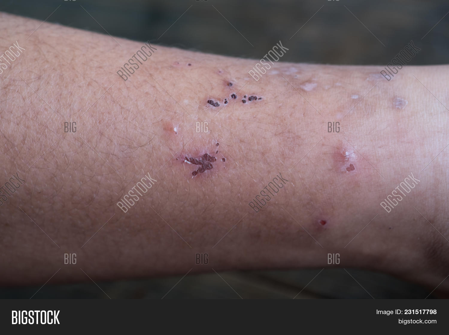 Wound Leg, Diabetic Image & Photo (Free Trial) Bigstock