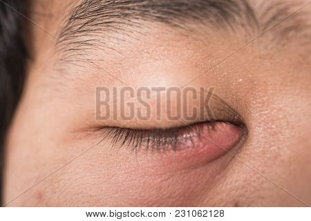 The Man Painfully Eye Stye