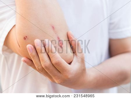 Man Show Red Lesion Or Wound On His Arm After Accident