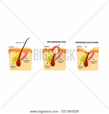 Open Comedones, Inflamed Acne, Cysts. Inflamed Pimples. The Structure Of The Skin. Scar Acne And Pim