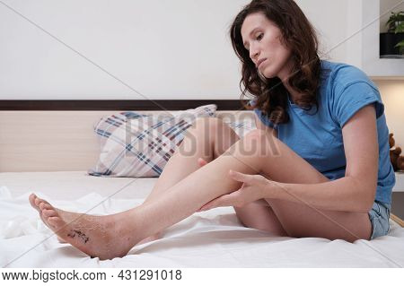 A Woman Sitting On The Bed Massages Her Leg After A Fracture. Home Rehabilitation After Injury. Mass