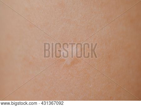 Close-up Of Scar Of Bcg Vaccination On The Human Arm.