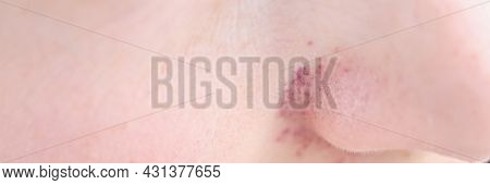 Red Cyanotic Rash On Woman Nose Closeup