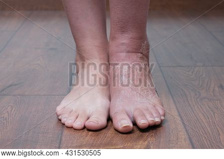 Two Legs Are On The Floor, One Leg Is Healthy, The Other Leg After A Cast. Differences Between Healt