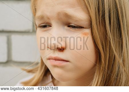 Portrait Girl With An Abrasion Under Her Eye. Child Abuse. Wounds And Abrasions