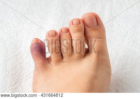 Purple Bruise On The Little Toe Of Female Person Foot. Injury Of Foot Little Finger After Home Accid